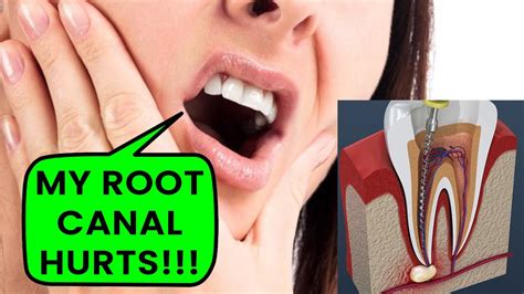 Why Do Root Canals Hurt So Much Live Root Canal Procedure Youtube