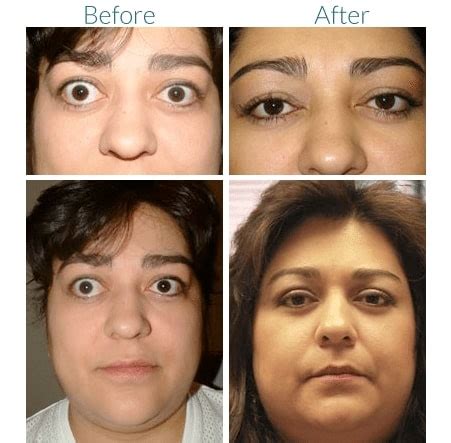 Graves Disease Treatment In Denver Thyroid Eye Disease Treatment CO