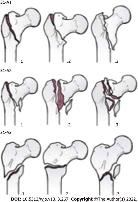 Comparative Study Of Intertrochanteric Fracture Fixation Using Proximal Femoral Nail With And
