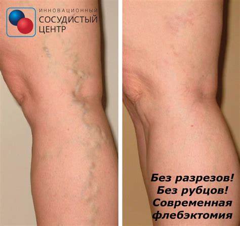 Диета при варикозе вен пищевода