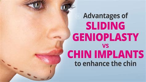 Advantages Of Chin Implant Augmentation Vs Sliding Genioplasty Youtube