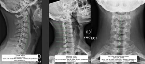 Normal Cervical Spine X Ray C N S Neurosurgery