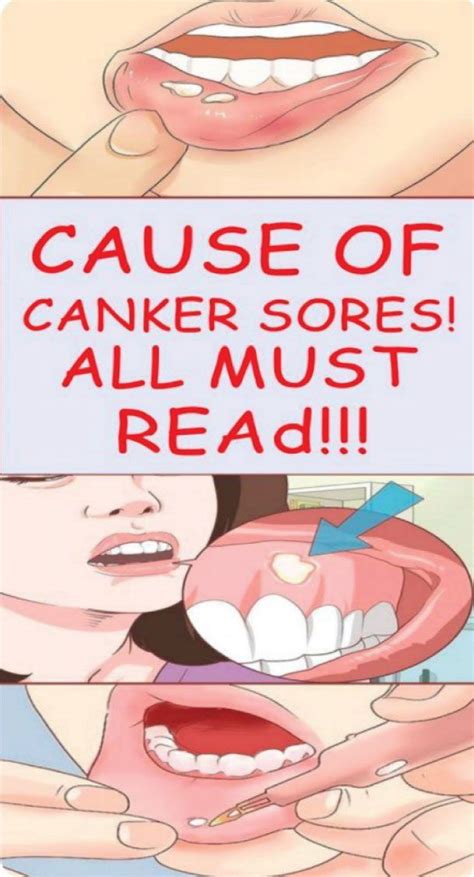 Cause Of Canker Sores Canker Sore Causes Canker Sore Cankers