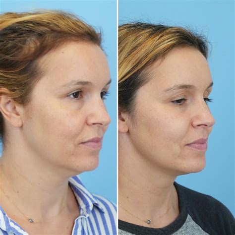 Patient 144687049 Thermitight Before And After Photos Bloom Facial