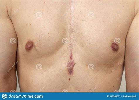 Open Heart Surgery Scar Stock Image Image Of Skin Operation