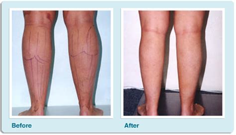 Calves And Ankles Liposuction At Crows Nest Cosmetics