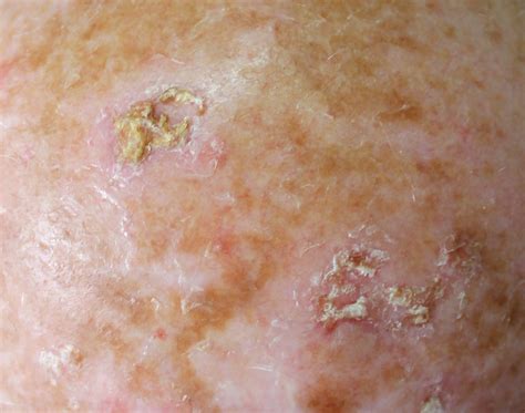 Shorter Duration Actinic Keratosis Treatments Linked To Higher Patient