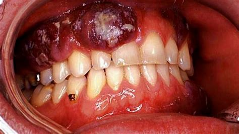 What Does Mouth Cancer Look Like Nhs Pin On Emergency Dentist Posts