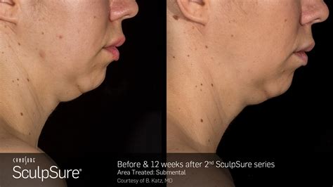 Sculpsure Submental Gig Harbor Wa Nouveau Medspas