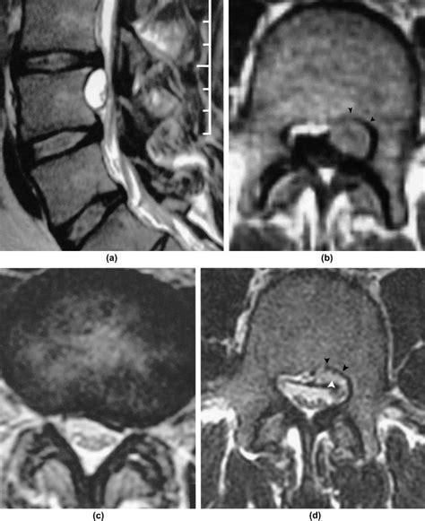 Mri Of Degenerative Cysts Of The Lumbar Spine Clinical Radiology