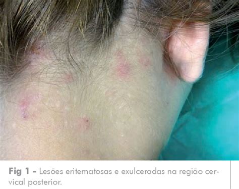 Figure 1 From Dermatite Herpetiforme Com ExacerbaÇÃo ClÍnica ApÓs