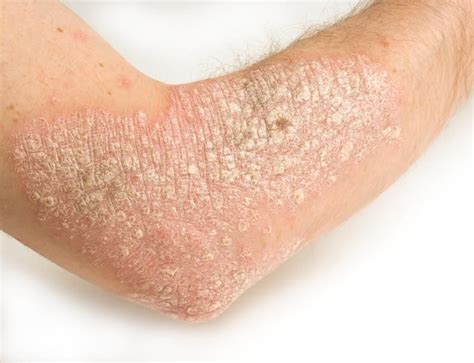 Pictures Of Skin Rashes Lovetoknow Treat Psoriasis Bow Legged