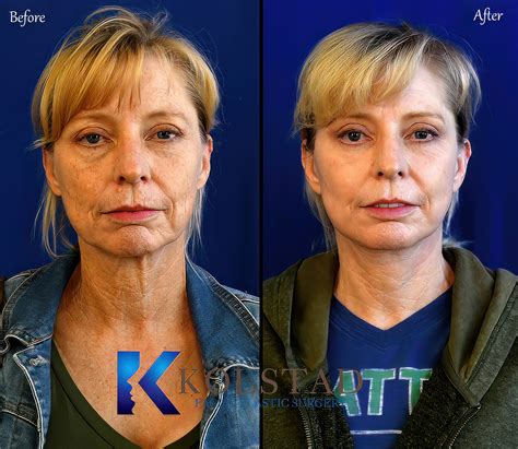 Facelift Before And After Gallery 4 Dr Kolstad San Diego Facial