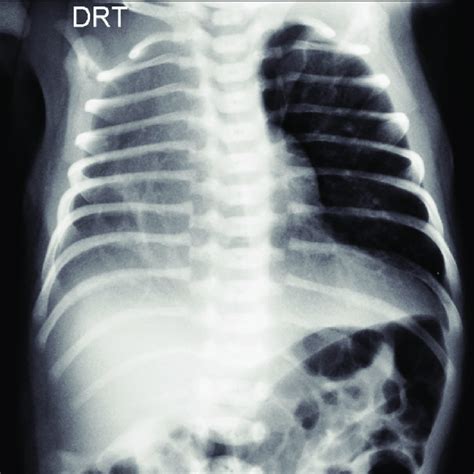Abs 39 Chest X Ray Hypoplastic Right Hemithorax And A Tubular