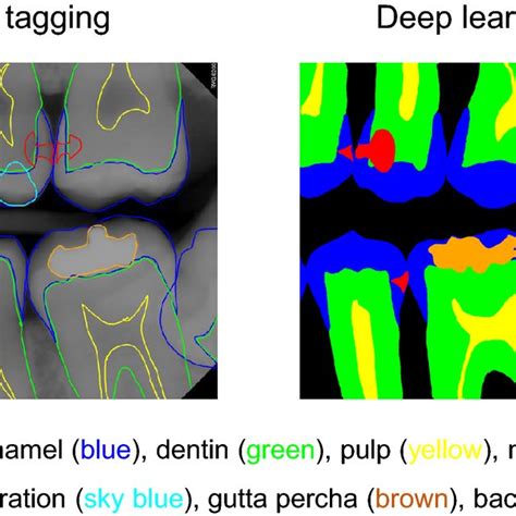 Pdf Deep Learning For Early Dental Caries Detection In Bitewing