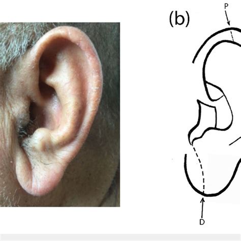 Pdf Paired Ear Creases Of The Helix Pech A Possible Physical Sign