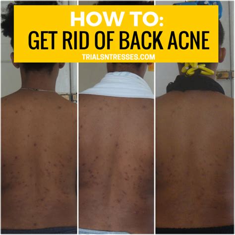 Skin Care How To Get Rid Of Back Acne Millennial In Debt Back Acne