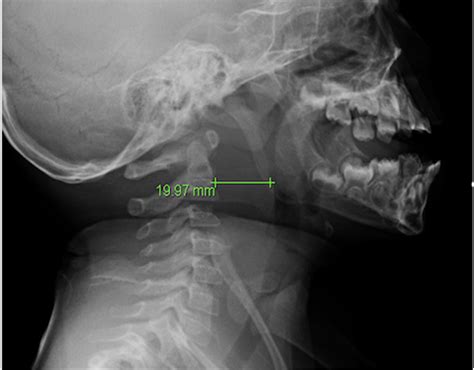 Retropharyngeal Space X Ray