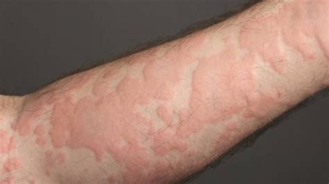 Hives On Skin Home Remedies