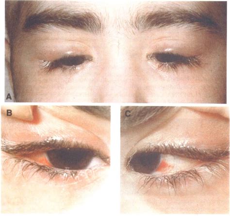 A Face Showing Bilateral Periorbital Oedema Especially In The Region