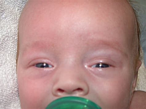 An Infant With The Setting Sun Eye Phenomenon Cmaj