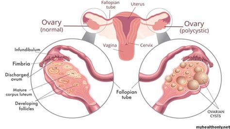 Polycystic Ovary Syndrome PCOS Symptoms Treatment And Causes