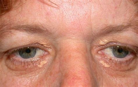 Soft Yellowish Lesions Or Spots On The Skin Typically Near The Eyes