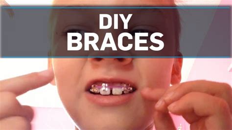 Orthodontists Warn Against Diy Braces Ctv News
