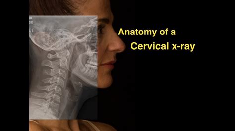Anatomy Of A Cervical X Ray Youtube