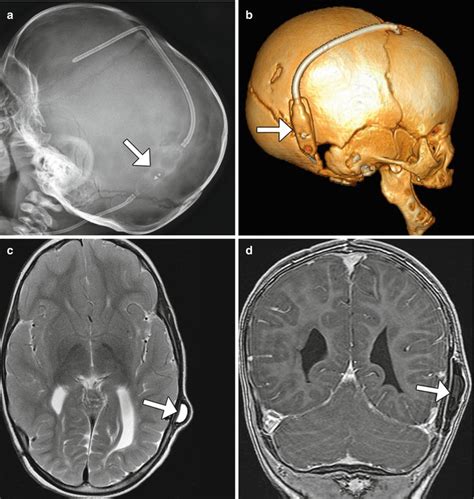 Imaging Of Cerebrospinal Fluid Shunts Drains And Diversion Techniques