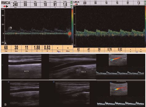 Transcranial Doppler And Cervical Vascular Ultrasound A Transcranial