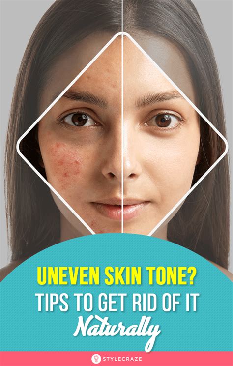 How To Fix Uneven Skin Tone Treatments Remedies And Tips Even Out