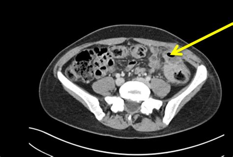 Colon Cancer Masquerading As Recurrent Abdominal Abscesses Journal Of