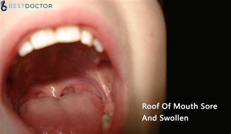 What Does Roof Of Mouth Sore And Swollen Mean Get Second Opinion Now