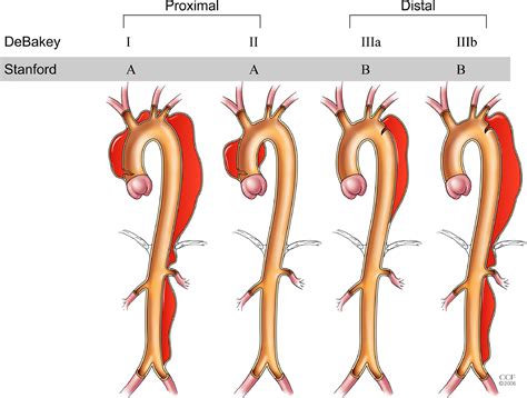 Management Of Acute Aortic Dissection During Critical Care Air Medical