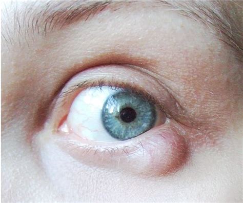 Homoeopathic Remedies For Eyelid Affections