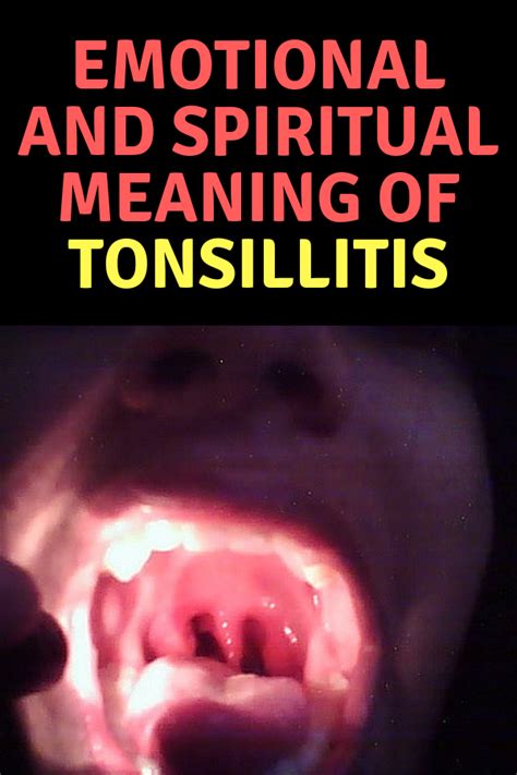 Pics Of Unhealthy Tonsils Tonsillitis High Fever Tonsilstonesnet Tonsil