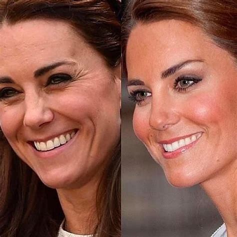 Plastic Surgery Clinic Used Kate S Face To Advertise Face Lifts Botox