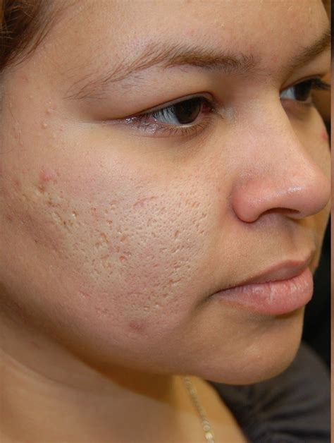 How To Get Rid Of Pitted Acne Scars Shearlingwomenbestquality