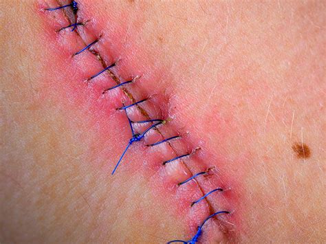 The skin around the ulcer can be discolored, raised, or thickened. Infected stitches: Symptoms, when to see a doctor, and ...