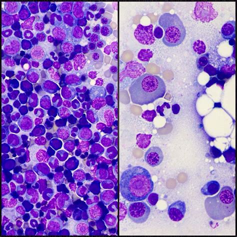 Myelodysplastic Syndrome Bone Marrow Cytology From A Cat Hematology