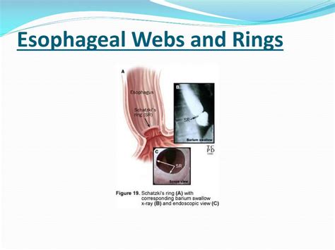 Ppt Management Of Dysphagia Powerpoint Presentation Free Download