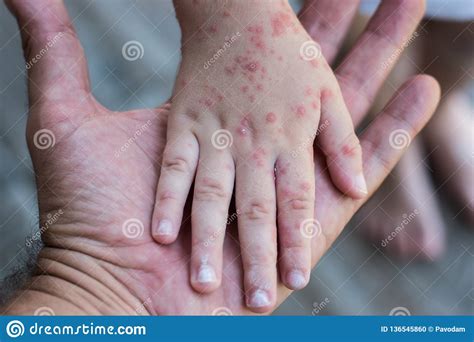 Red Rash On Hands And Feet Atopic Dermatitis Symptoms