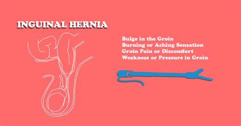 Inguinal Hernia Symptoms Causes Diagnosis Treatment