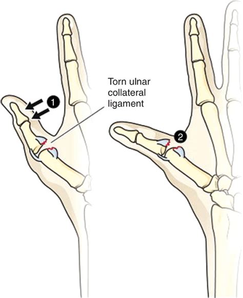 Ulnar Collateral Ligament Tear Of The Thumb Ski Pole Or Gamekeepers Thumb Anesthesia Key