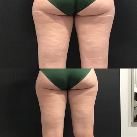 cellulite treatment before and after photos ultra body sculpt