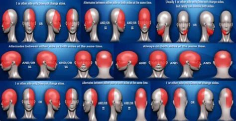 Types Of Headaches And Headache Location Chart Virtual Headache Specialist