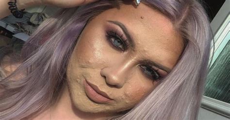 Student Who Covers Acne With Makeup Refuses To Date In Case Men Feel