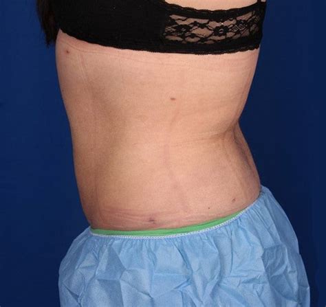 Liposuction Before And After Photos Palm Desert Palm Springs