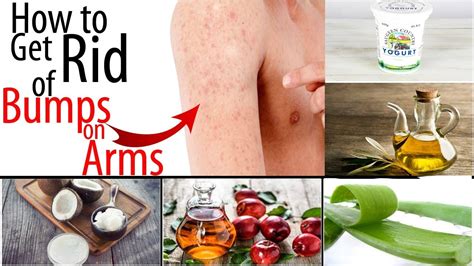 How To Get Rid Of Tiny Red Bumps Rashes From Arms Chicken Skin